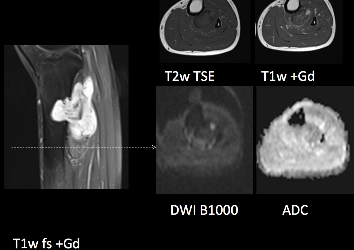 Figure 5 for case Dedifferentiated liposarcoma ( RID4360 )